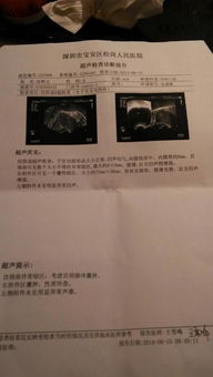 38岁抗癌博主患卵巢恶性肿瘤离世